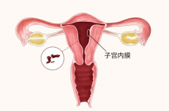 子宫内膜薄如何调理？经过多久治疗能成功怀孕？