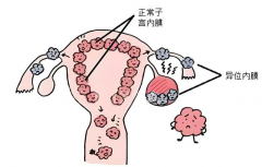 子宫内膜异位症做试管婴儿成功率并不低，不必担心怀孕问题！