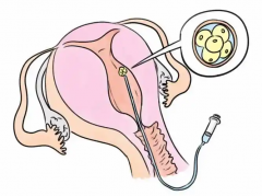 促排期间，掌握这些要点，卵泡又大又好！