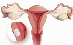 子宫内膜回声不均匀是什么原因导致的？对女性生育和健康都有影响！