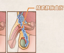 科普精索静脉曲张知识，患者需做好这些才能提高试管成功率！