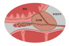 前列腺炎能做试管婴儿吗？有什么影响一看便知！