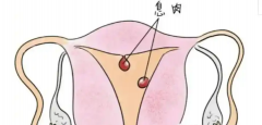 子宫内膜息肉对试管婴儿有没有影响？应该怎么处理？