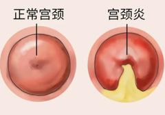 宫颈炎可能造成试管移植失败，一定要注意控制！