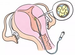 揭秘！子宫内膜息肉患者能否做试管婴儿？生育专家全面解析