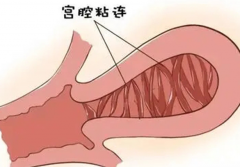 宫腔粘连容易导致女性不孕，引发疾病原因总结！