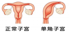 单角子宫能做试管婴儿吗？多少费用可以搞定？