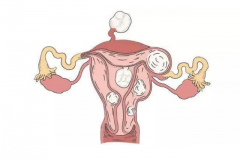 卵巢囊肿患者能否尝试试管婴儿？全面解析试管婴儿技术对卵巢囊肿患