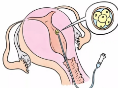 女性试管取卵手术流程全解，附取卵注意事项！