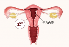 盘点子宫内膜厚需要刮宫情况，看下你在其中吗？