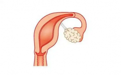 单角子宫怎么才能怀孕？必须满足这几个条件才行！