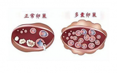 多囊卵巢的几种典型症状，有问题一定要及时治疗！