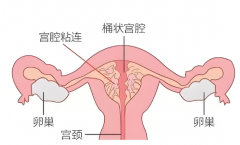 宫腔粘连能否阻挡生育路？关键看粘连程度！